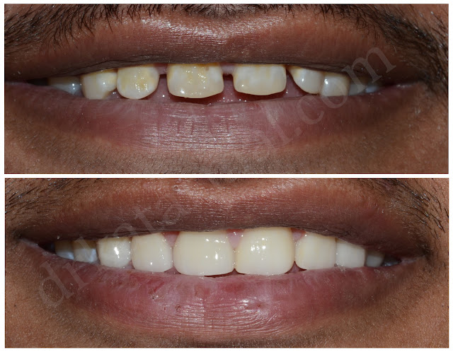 Smile Design for Spacing between Teeth at Jamnagar