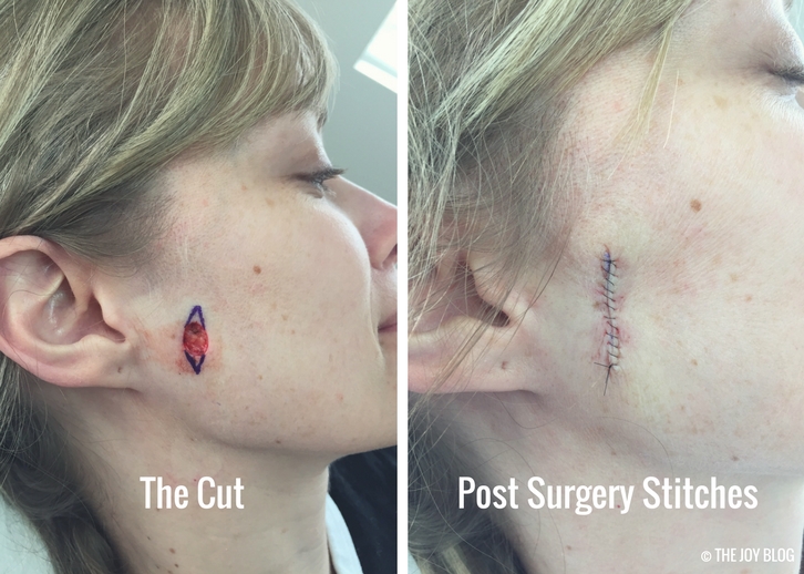 Basal Cell Carcinoma & Mohs Surgery // www.thejoyblog.net