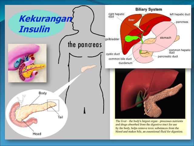 Kekurangan Insulin