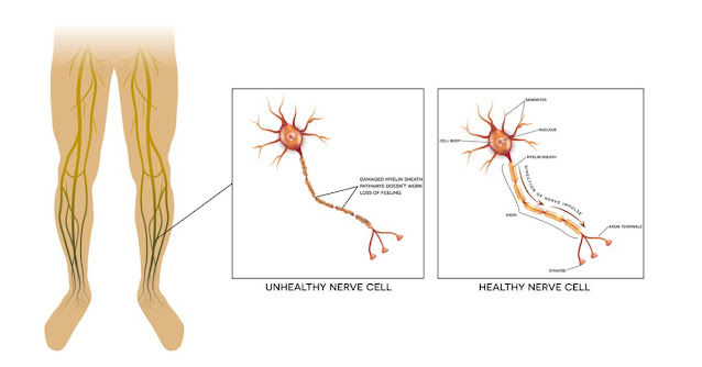 Peripheral Nerve Injury - Healthegy