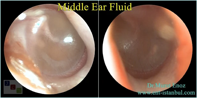 Otitis Media With Effusion,serous otitis media,OME,Secretory Otitis Media,Middle Ear Fluid,Symptoms of Serous Otitis Media,