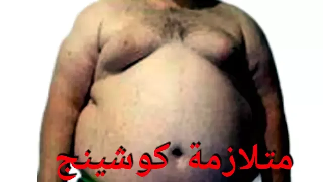 فرط نشاط قشرة الكظر