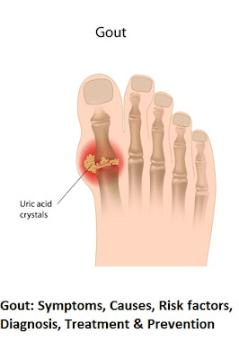 Gout: Symptoms, Causes, Risk factors, Treatment & Prevention