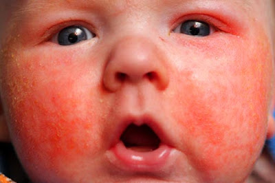 Psoriasis In Children: Treatment, Symptoms And Causes