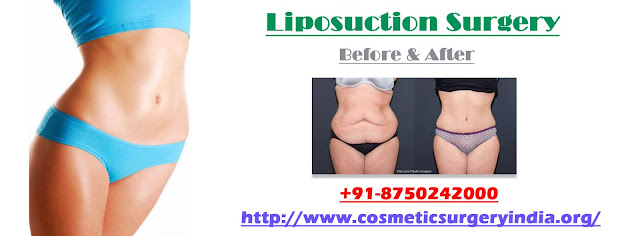   Liposuction Surgery in Delhi