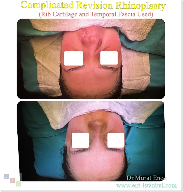 Complicated Revision Rhinoplasty (Rib Cartilage and Temporal Fascia Used)