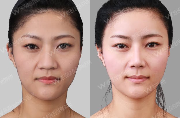 짱이뻐! - [Before and After Photos] Korean Rhinoplasty