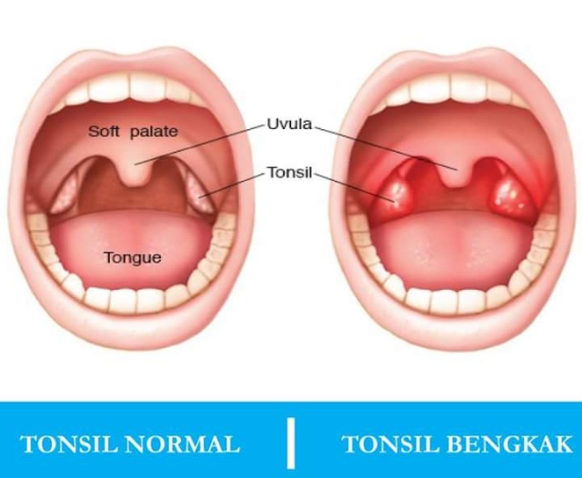 Demam Sebab Bengkak Tonsil