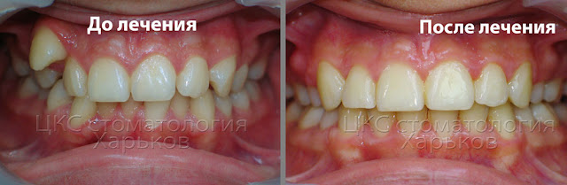 Фото до и после лечения нарушенного  положения средней линии зубов