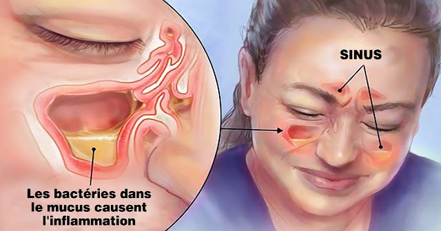 infection des sinus