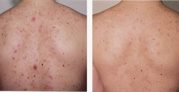 how to get rid of back acne scars