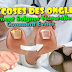 Mycoses des Ongles  Comment Soigner Naturellement & Comment l'éviter