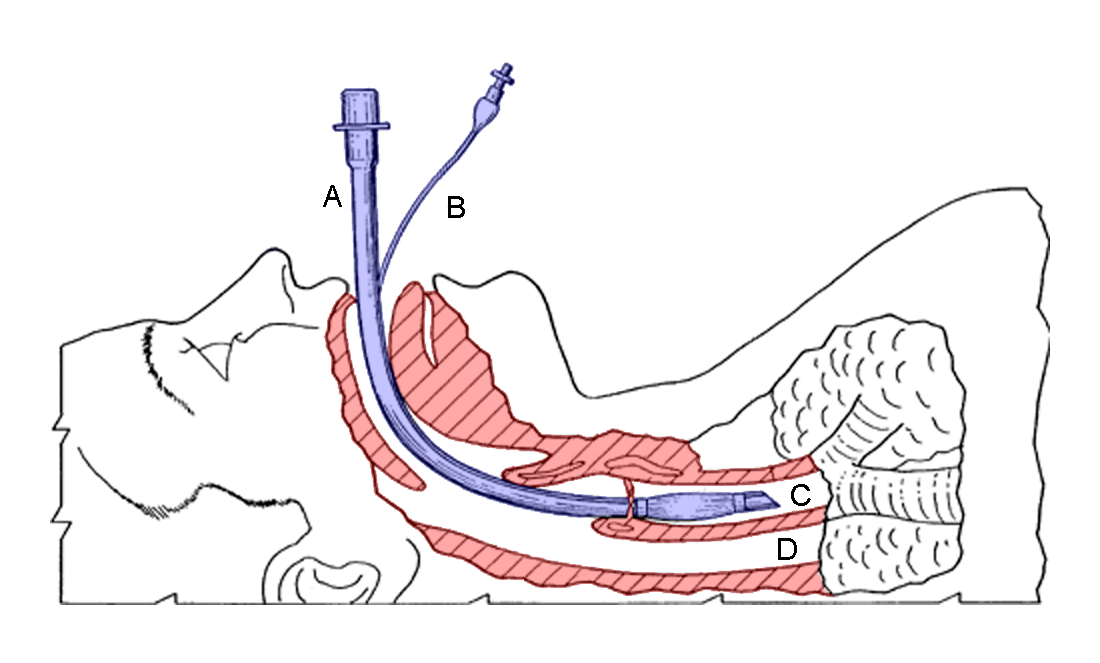 氣管插管 Intubation