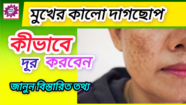 How to Remove Pigmentation