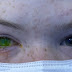 Austrália tem aumento do número de casos de doença que causa olhos verdes e dor