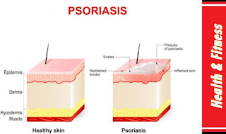 psoriasis-diagnosis-treatment