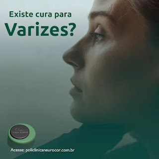 Existe cura para varizes?