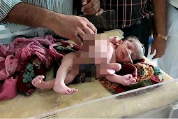 Viral Bayi Lahir dengan 4 Kaki dan Tiga Tangan, Sang Ibu Kaget Harusnya Melahirkan Anak Kembar