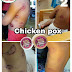 Penawar Chicken Pox