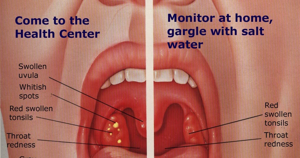 AlanG: Pembedahan Radang Tonsil