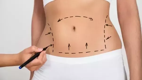 Liposuction in Jaipur