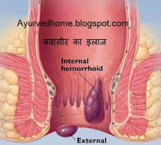 Piles Ka Ilaj in Hindi , अर्श की बीमारी का ईलाज