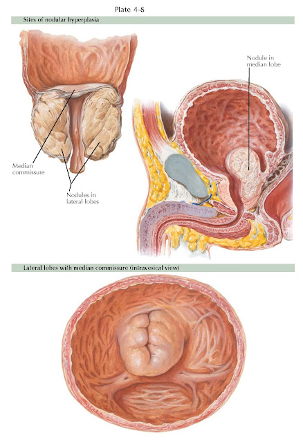 BENIGN PROSTATIC HYPERPLASIA II: SITES OF HYPERPLASIA AND ETIOLOGY