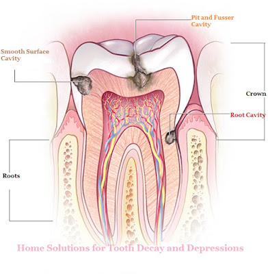 Home Solutions for Tooth Decay and Depressions