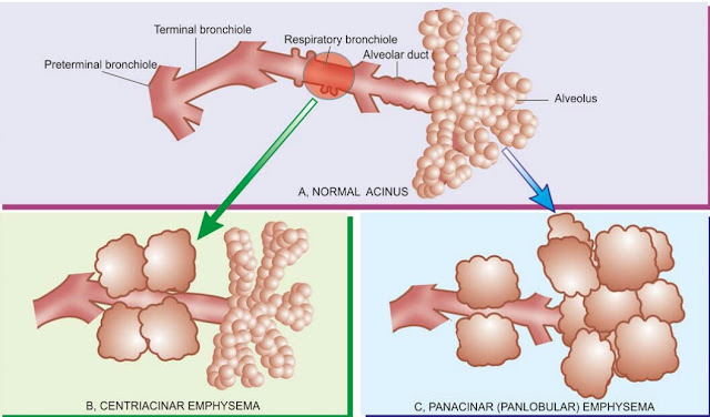 anatomical involvement of the lungs, aas, emphysema, centriacinar emphysema