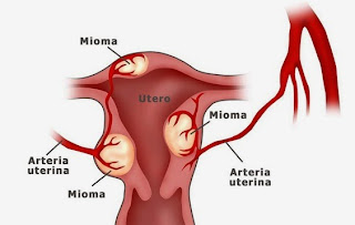 Terapi Non farmakologi Penyakit Miom nyeri pada rahim lokasi nyeri waktu menstruasi