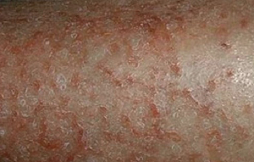  Penyakit Kulit Dermatitis Atopik Gejala Penyebab Cara 