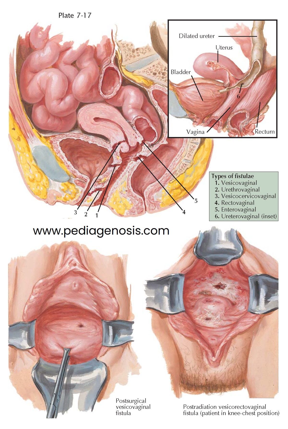 FISTULAE