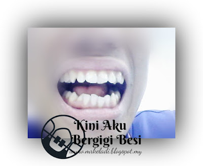 Perlu pakai braces ke tidak?