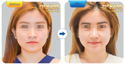 Hình ảnh trước và sau khi thu gọn cánh mũi tại Bệnh viện thẩm mỹ KIM