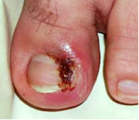 An infected toe can be caused due to several reasons. One of the most prominent of causes for an infected toe is an ingrown toenail. Literally, an ingrown toenail depicts the growth of a toenail inwards into the skin. This usually happens on the big 