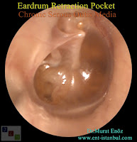 tympanic membrane retraction pocket,Tympanic Membrane Retraction,tympanic membrane atelectasis,Retracted Eardrum,