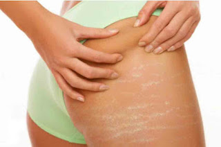 The Benefits of Baby Oil for Stretch Mark 