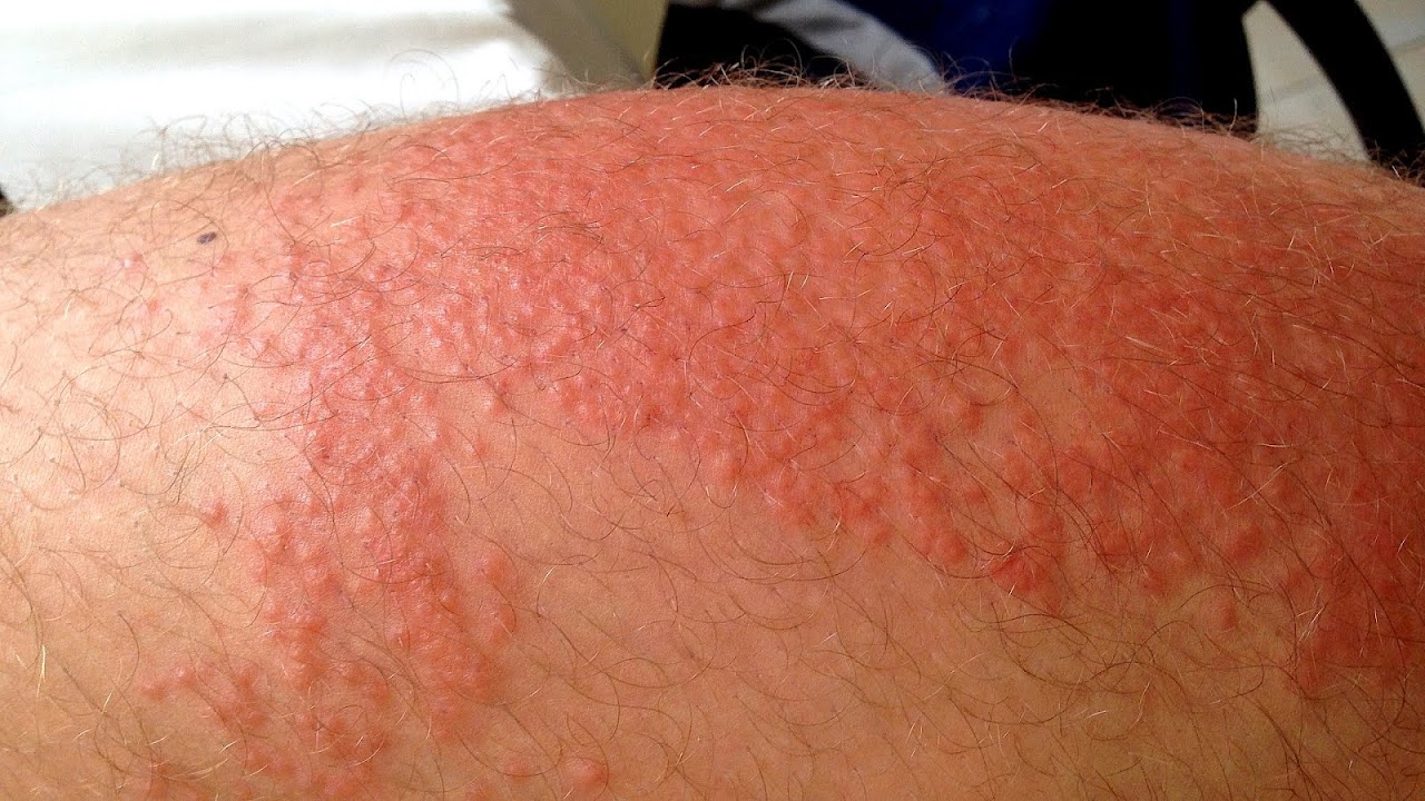 Itchy Skin Rash All Over Body
