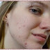 Qual é o melhor contra a acne: isotretinoína, antibiótico ou ácido retinóico?