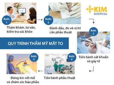 Tìm hiểu công nghệ phẫu thuật mắt đẹp 02