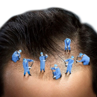 Hair transplant in Navi Mumbai