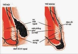 Chế độ dinh dưỡng cho người mắc bệnh trĩ