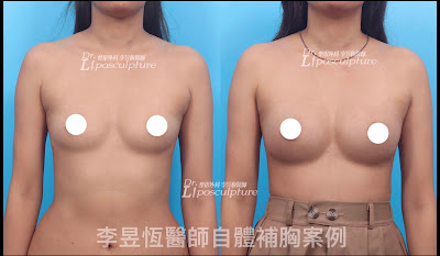 台中自體脂肪隆乳推薦