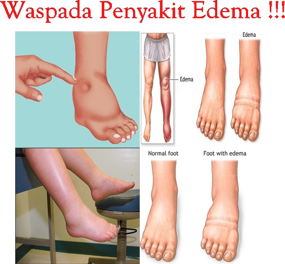 Obat Tradisional Penyakit Edema