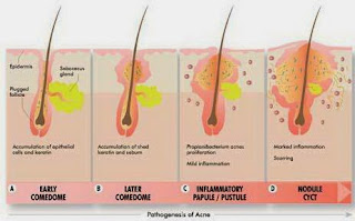 Cara Menghilangkan Jerawat Dengan Obat Herbal