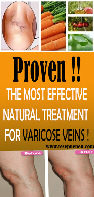 THE MOST EFFECTIVE NATURAL TREATMENT FOR VARICOSE VEINS!