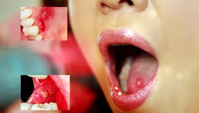 Tìm hiểu nguyên nhân gây ra bệnh nấm miệng