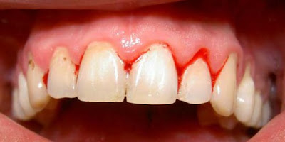  Nguyên nhân nướu răng bị chảy máu