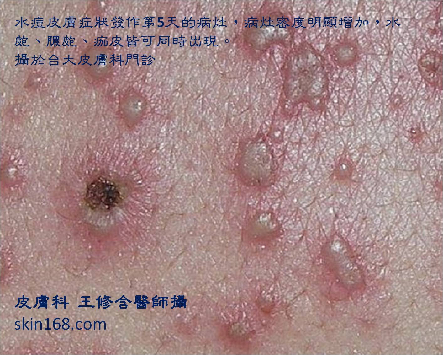 皮膚科王修含醫師 水痘十大須知 皮膚科王修含醫師 水痘十大須知