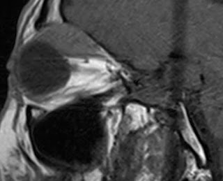 Resonancia orbita sagital T1